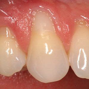 How To Stop Receding Gums OraWellness Gum Recession Receding Gums