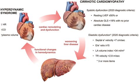 Cardiac Syndromes In Liver Disease A Clinical Conundrum