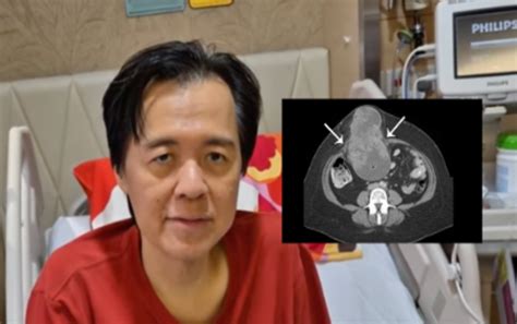 Doc Willie Ong S Sarcoma Shrinks By 60 In 6 Weeks NewsFeed