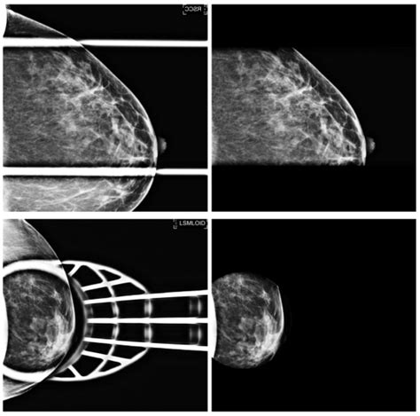 Examples of special magnification and spot compression views (left) and ...