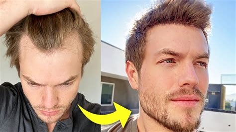 My Turkey Hair Transplant 4 Month Update Before And After Youtube