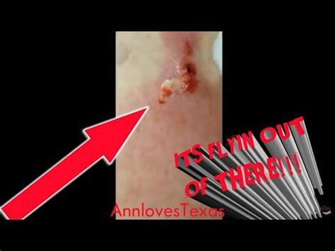 3 Days Progression in an abscess... : r/popping