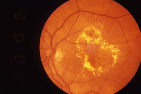 Focal Diabetic Maculopathy