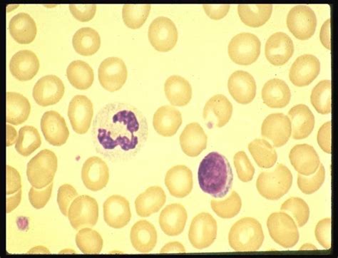 Update on (Approach to) Anemia