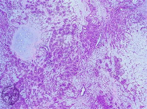 7oral Salivary Gland 7 Salivary Gland Tumor Pleomorphic Adenoma