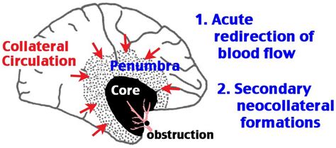 Frontiers Impaired Post Stroke Collateral Circulation In Sickle Cell