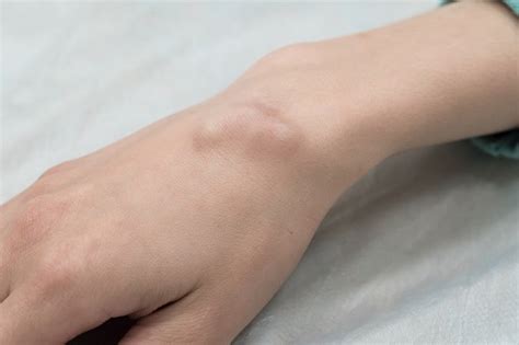 Xanthoma Benjolan Lemak Yang Muncul Di Kulit Alodokter