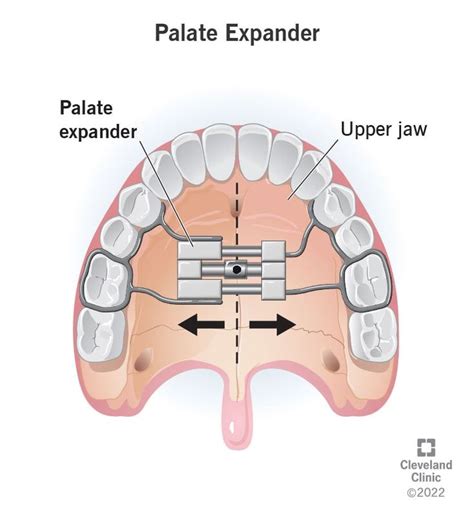 Palate Expander Uses Types Adjusting Palate Expander Palate