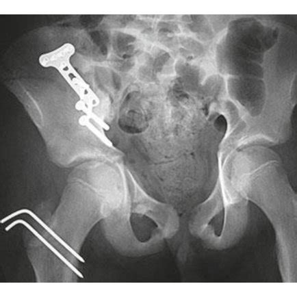 Postoperative AP Pelvic X Ray Showing Adequate Open Reduction Internal