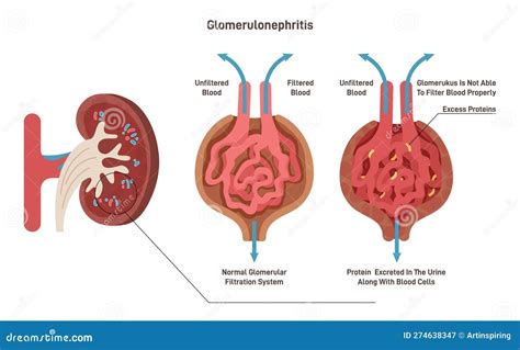 Glomerulonephritis Urine