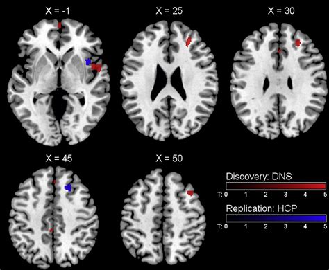 Convergent Evidence For Predispositional Effects Of Brain Gray Matter