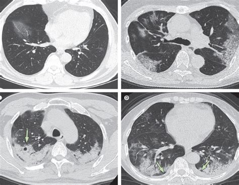 Procedure For Chest Magnetic Resonance Imaging Without Injection Of