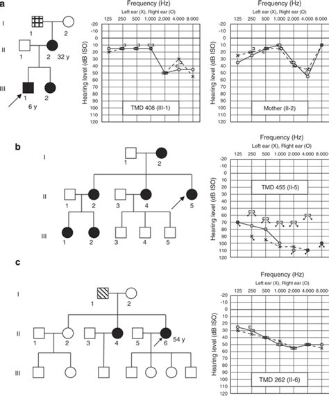 Pedigrees Of The Families And Audiograms Of Patient Tmd And His