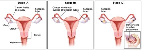 Fallopian Tube Function - Pregnancy - Blocked Fallopian Tube