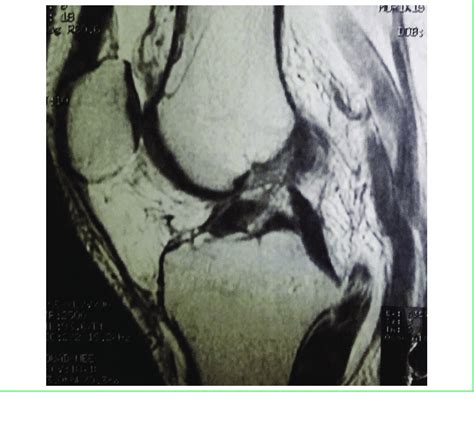 Acute anterior cruciate ligament tear on an MRI. | Download Scientific ...