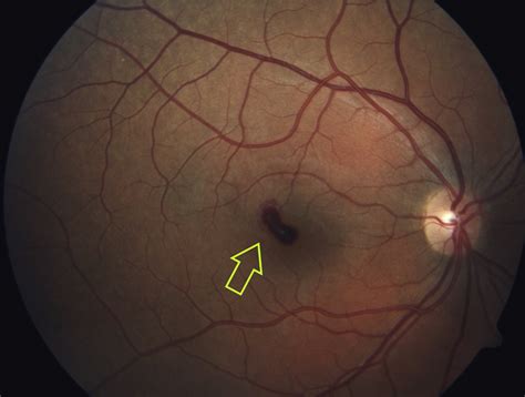 A Unique Case Of Valsalva Retinopathy Preretinal Hemorrhage Identified