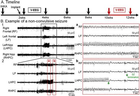 A Spontaneous Non Convulsive Seizure Recorded 10 12 Wks Post Ihka A