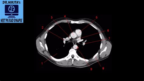 Part Ct Thorax Normal Anatomy Youtube