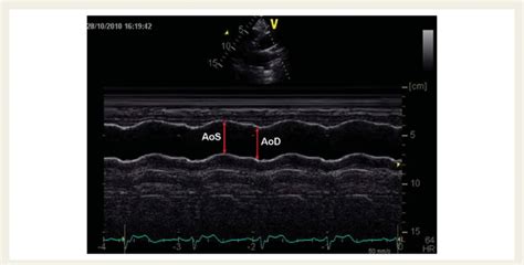 Measurements Of Systolic Aos And Diastolic Aod Diameters Of The