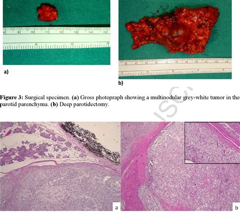 Figure 3 From Clear Cell Myoepithelial Carcinoma Ex Pleomorphic Adenoma Of Parotid Gland Case