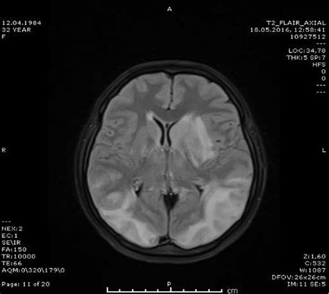 Hypointense lesions on FLAIR sections FLAIR: Fluid-attenuated inversion ...