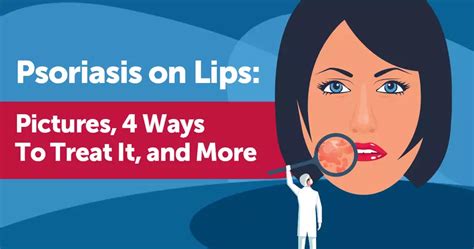 Psoriasis on Lips: Pictures, 4 Ways To Treat It, and More | MyPsoriasisTeam