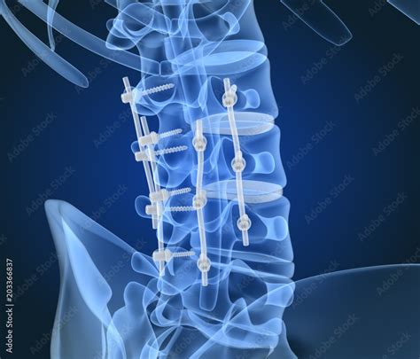 Spinal Fixation System Titanium Bracket X Ray 3d Illustration Stock