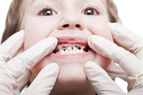 Un Programa De Salud Dental En Colegios Reduce Las Caries En M S Del