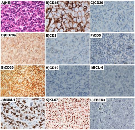 Typical Morphology And Immunophenotype Of CD20 Negative Diffuse Large