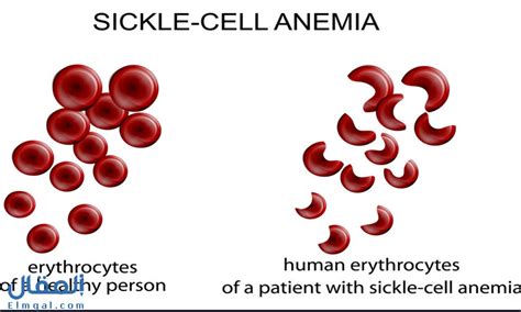 فقر الدم المنجلي ما أسبابه وانواعه وطرق تشخيصه والعلاج المناسب له