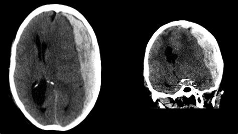 Acute Vs Chronic Subdural Hematoma