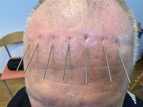 Unlocking Hope The Healing Power Of Scalp Acupuncture In Stroke