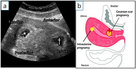 Successful Full Term Delivery Via Selective Ectopic Embryo Reduction