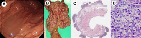 A Endoscopic Imaging Of The Stomach Showing Numerous Elevated