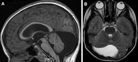 Retrocerebellar Arachnoid Cyst