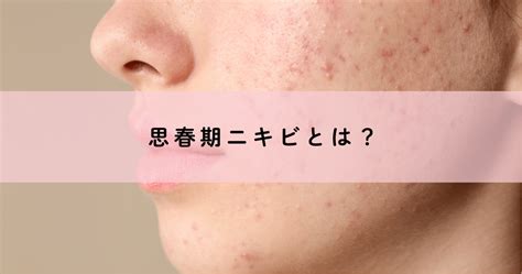 思春期ニキビとは？ 【池袋 美容皮膚科】カロンクリニックコラム