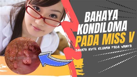 Seberapa Bahaya Kondiloma KUTIL KELAMIN Pada Vagina YouTube