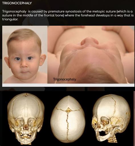 Trigonocephaly