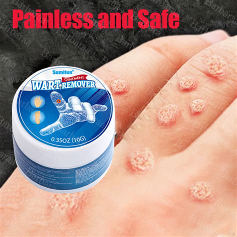 Fast Painlessoriginal Sumifun Warts Remover Cream G Warts Remover