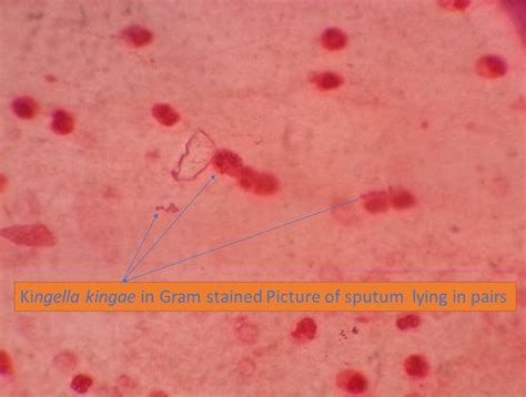 Kingella kingae : Introduction, Pathogenecity, Lab Diagnosis and Treatment