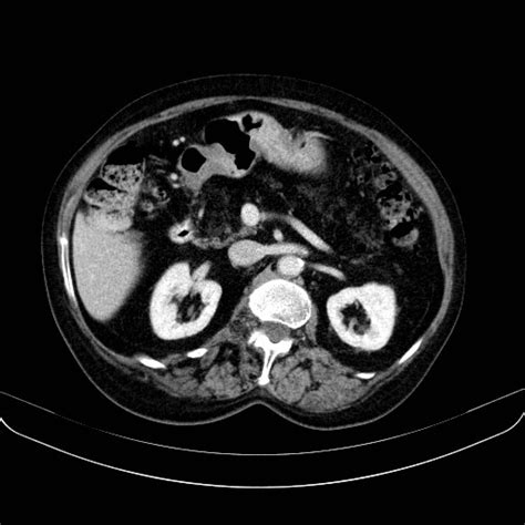 Radiopaedia case Aging fatty replacement of the pancreas id: 27501 ...