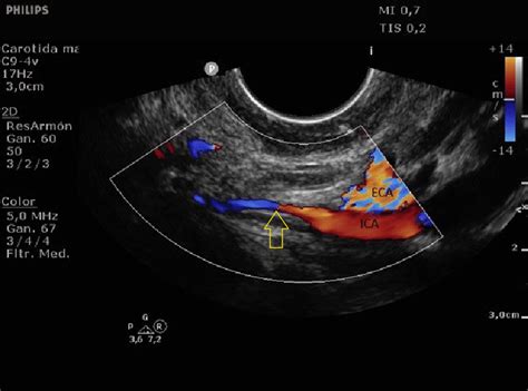 Transoral Ultrasonography Yellow Arrow Homogeneous Hypoechoic Image Download Scientific