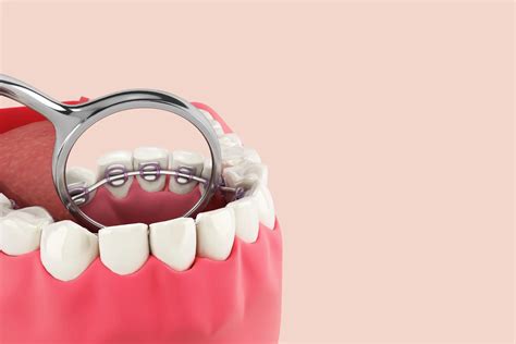 What Are Lingual Braces Price Pros And Cons All About Smiles