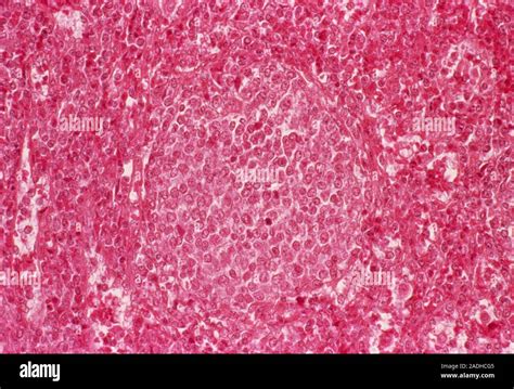 Spleen Cancer Light Micrograph Of A Section Through Tissue From The