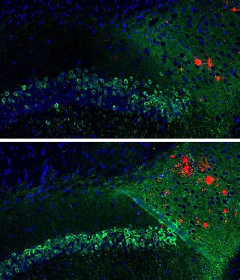 Dna Vaccine Reduces Both Toxic Proteins Linked To Alzheimers