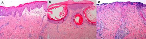 Histopathology Of The Skin Lesions Histopathology Hematoxylin Eosin