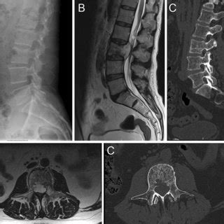 A Year Old Patient Affected By A Chordoma Of The L Level The X Ray