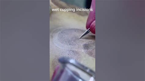 Hijamah Wet Cupping Incisions Shorts Youtube