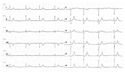 Medicina Free Full Text Management Of Complete Heart Block In A