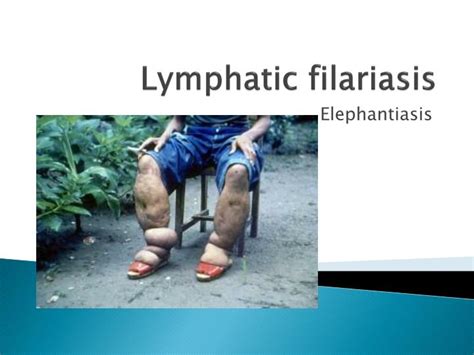 PPT - Lymphatic filariasis PowerPoint Presentation, free download - ID ...